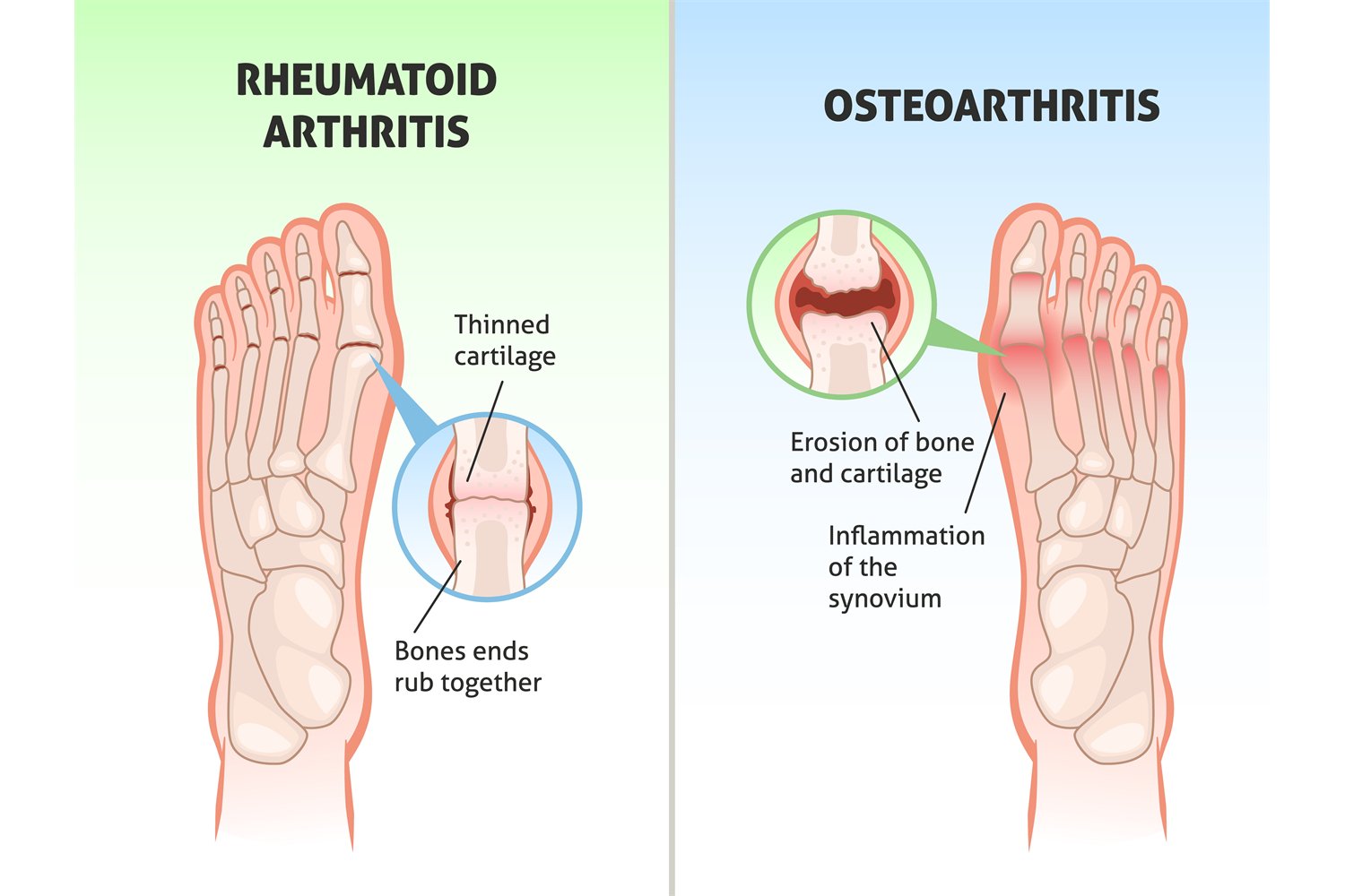 Rheumatoid Arthritis Foot Heel Pain And Ankle Swelling Natural