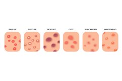 Acne types. Facial infections, pimples and skin inflammation Product Image 1