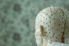 Acupuncturist applying needles to patient&#039;s head for treatme Product Image 1