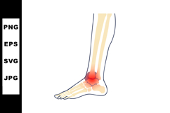 Human ankle joint anatomy illustration highlighting inflamma Product Image 1