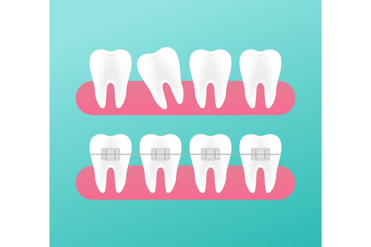 Correction of teeth with orthodontic braces. Stages of teeth example image 1