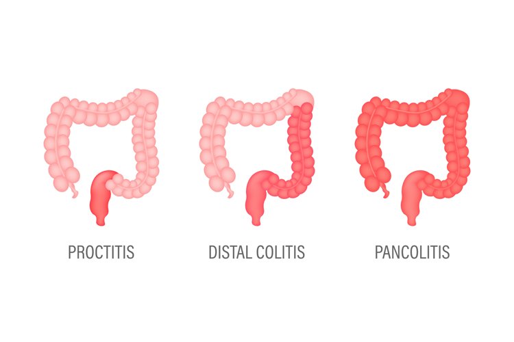 Colitis for medical design. Gastroenterology. Gut constipati example image 1