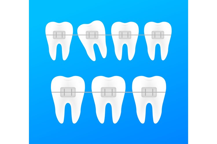 Correction of teeth with orthodontic braces. Stages of teeth example image 1